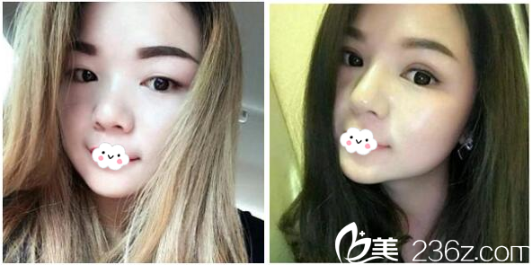 東莞締美整形醫(yī)院陳星光雙眼皮案例 東莞締美整形醫(yī)院陳星光雙眼皮案例