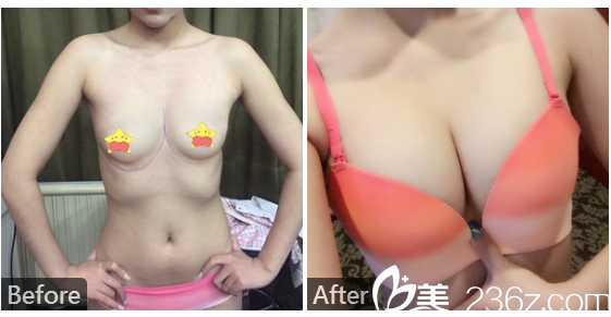 東莞締美整形醫(yī)院陳星光隆胸案例 東莞締美整形醫(yī)院陳星光隆胸案例