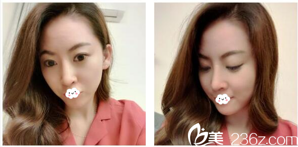 瞞著爸媽找東莞締美整形醫(yī)院趙可醫(yī)生做的隆鼻效果還挺好看