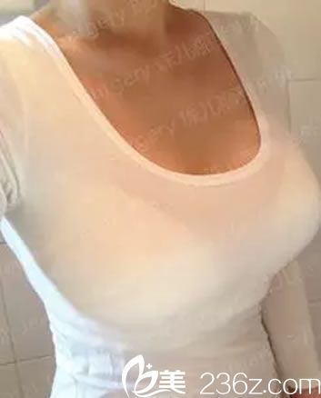 韓國珠兒麗假體隆胸手術(shù)5個月效果