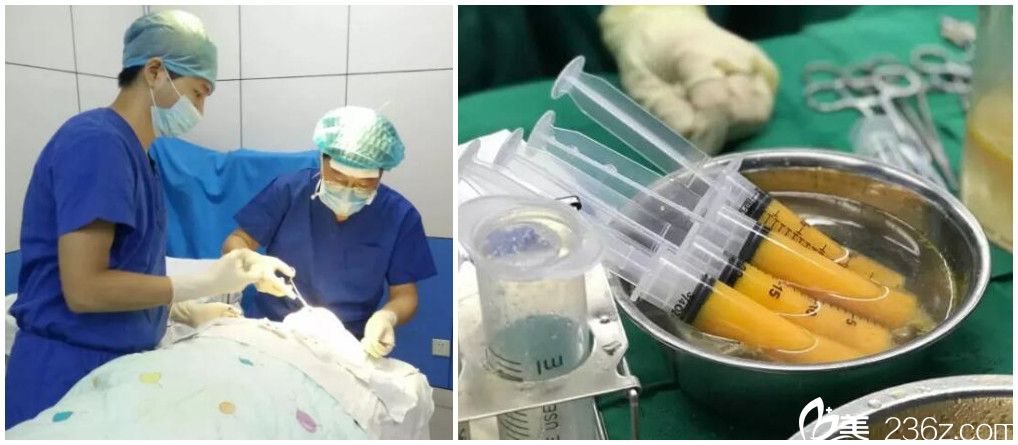 自體脂肪填充全臉手術(shù)過程 自體脂肪填充全臉手術(shù)過程