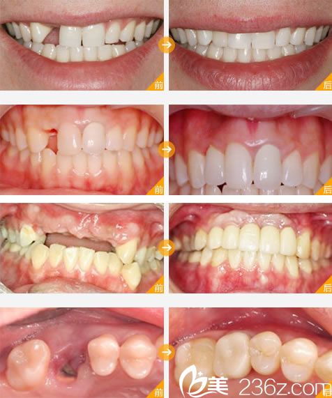寧波牙博士王道軍種植牙案例 寧波牙博士王道軍種植牙案例