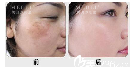 微針案例 微針案例