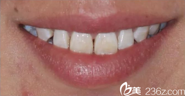 尤樂平牙修復(fù)術(shù)前 尤樂平牙修復(fù)術(shù)前