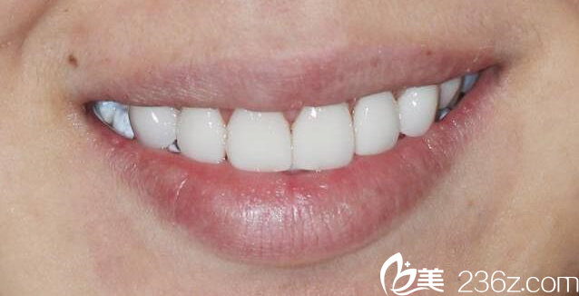 術(shù)后 術(shù)后