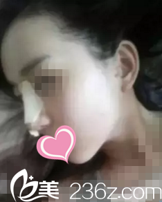 術后第三天 術后第三天