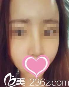 術后半個月效果 術后半個月效果