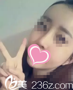 術后20天恢復情況 術后20天恢復情況