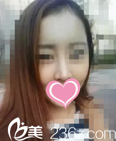 在丹東李紅明星整形醫(yī)院做的假體隆鼻后，我如愿擁有了高挺小俏鼻