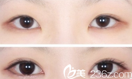 廣州壹加壹項美蓮埋線雙眼皮失敗修復(fù)案例