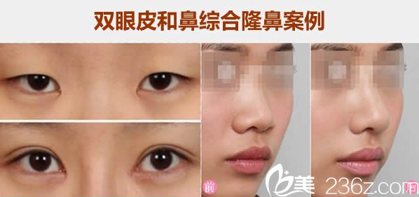 <!--<i data=20240703-sp></i>-->薇格雙眼皮和鼻綜合隆鼻案例