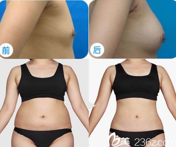 廈門薇格自體脂肪隆胸和腰腹吸脂案例 廈門薇格自體脂肪隆胸和腰腹吸脂案例