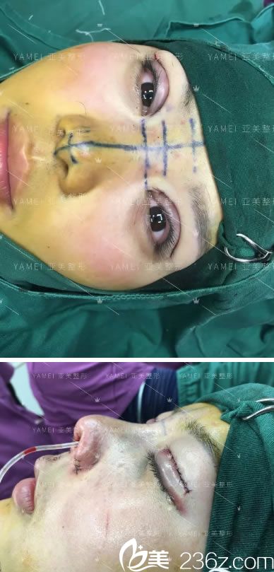 金華亞美眼鼻綜合整形手術(shù)即刻<span style=