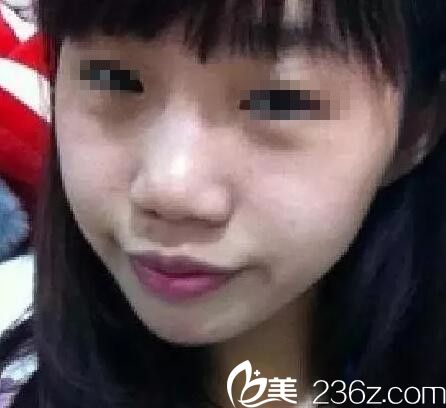 隆鼻術(shù)前 隆鼻術(shù)前