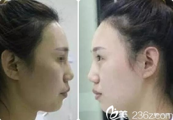 側(cè)面看鼻子塌嘴巴凸 側(cè)面看鼻子塌嘴巴凸