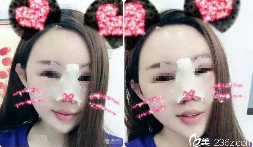 隆鼻+脂肪填充術(shù)后即刻 隆鼻+脂肪填充術(shù)后即刻