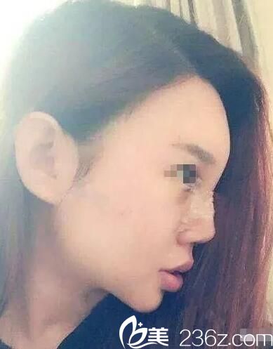 術(shù)后第七天鼻部拆線恢復(fù) 術(shù)后第七天鼻部拆線恢復(fù)