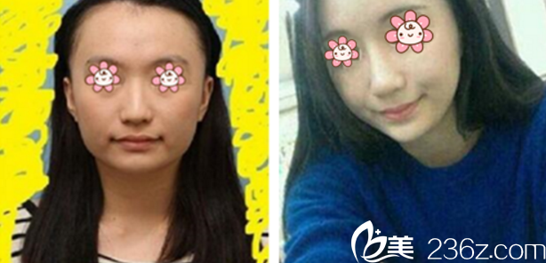 韓國(guó)Dr.朵整形林贊洙下頜角磨骨對(duì)比圖 韓國(guó)Dr.朵整形林贊洙下頜角磨骨對(duì)比圖