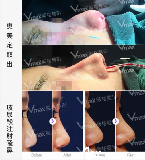 廈門薇格高勇注射隆鼻和鼻部奧美定取出案例 廈門薇格高勇注射隆鼻和鼻部奧美定取出案例