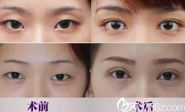 劉輔蓉切開雙眼皮15天恢復效果圖