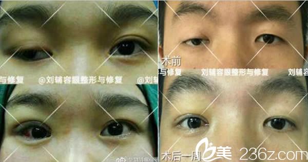 劉輔蓉雙眼皮失敗修復案例