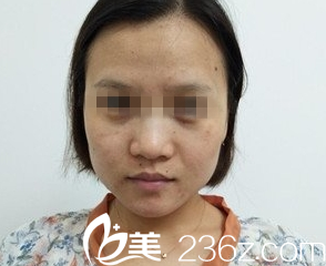 重慶光博士案例術(shù)前 重慶光博士案例術(shù)前