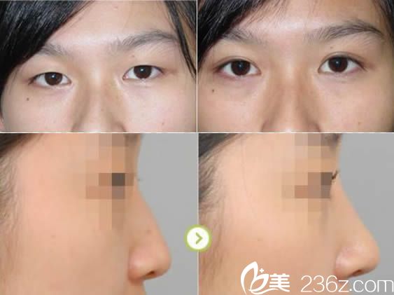 廈門華美林劍超雙眼皮和假體隆鼻案例 廈門華美林劍超雙眼皮和假體隆鼻案例