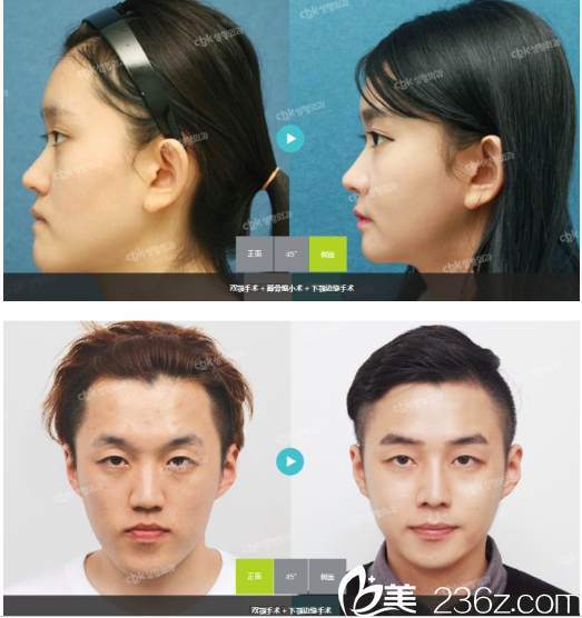 崔鳳均院長雙鄂手術(shù)真人案例 崔鳳均院長雙鄂手術(shù)真人案例