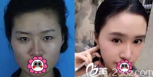 我在長春麥西美嘉做改臉型+眼鼻整形前后對比