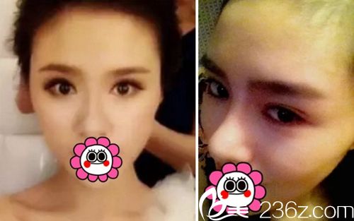 我在長春麥西美嘉做改臉型+眼鼻整形術后3個月