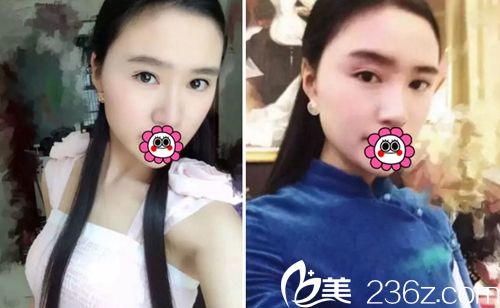 我在長春麥西美嘉做改臉型+眼鼻整形術后半年