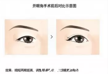 割了雙眼皮眼睛還是?。块L(zhǎng)春麥西美嘉開(kāi)眼角11800元起幫你塑造美眼