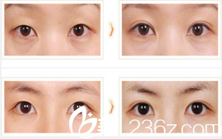 韓國首爾整形醫(yī)院薄眼皮，大眼睛手術(shù)