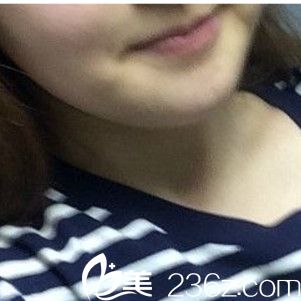 激光溶脂手術(shù)后十天