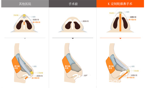K整形醫(yī)院定制輪廓鼻整形