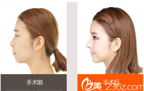 金院長鼻部整形真人案例 金院長鼻部整形真人案例