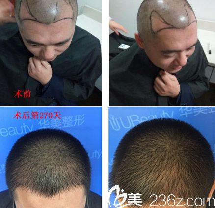 合肥華美整形美容醫(yī)院官駒赳做頭發(fā)種植案例前后效果對比