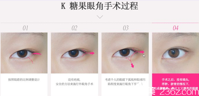 K糖果眼角手術(shù)過程