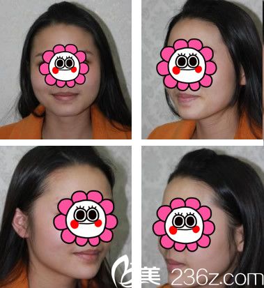 在合肥華美整形美容醫(yī)院找官駒赳做玻尿酸隆下巴案例