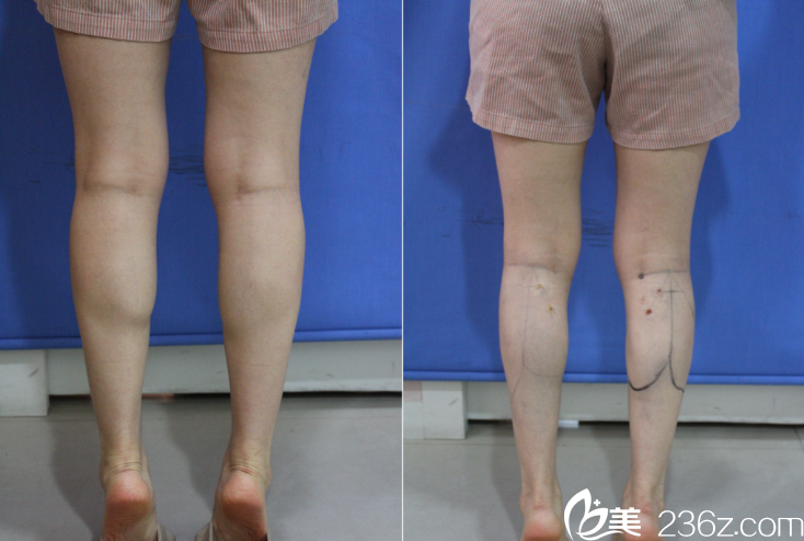 李俊宇院長小腿塑形案例 李俊宇院長小腿塑形案例