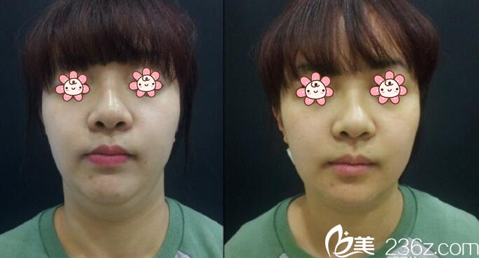 李俊宇院長面部吸脂案例 李俊宇院長面部吸脂案例