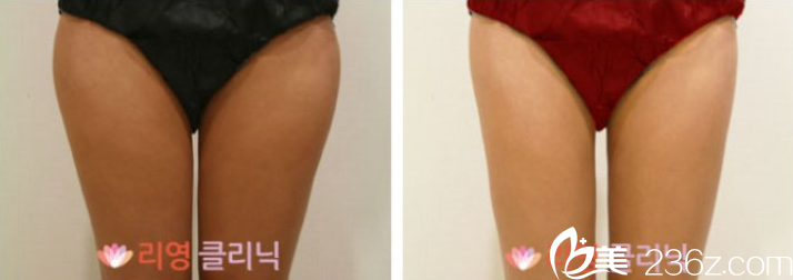 嚴(yán)日準(zhǔn)院長大腿吸脂案例 嚴(yán)日準(zhǔn)院長大腿吸脂案例