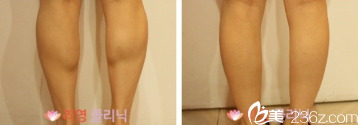 小腿塑形案例 小腿塑形案例
