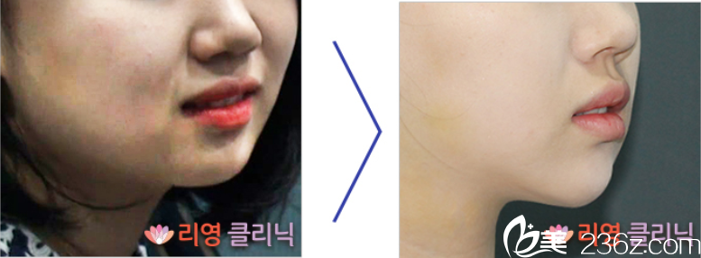 崔峻榮院長面部吸脂案例1 崔峻榮院長面部吸脂案例1