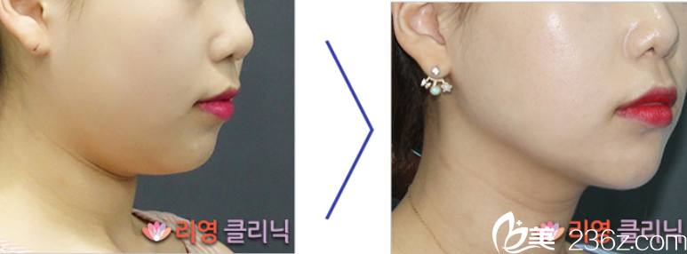 崔院長面部吸脂案例2 崔院長面部吸脂案例2