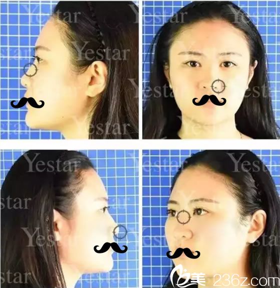 做鼻綜合手術(shù)前的全方面塌鼻子照片 做鼻綜合手術(shù)前的全方面塌鼻子照片