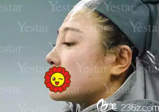 做完鼻綜合整形手術(shù)即刻<span style= 做完鼻綜合整形手術(shù)即刻<span style=