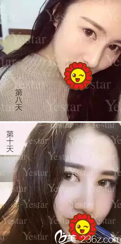 鼻綜合整形手術(shù)第8天和第10天恢復(fù)照 鼻綜合整形手術(shù)第8天和第10天恢復(fù)照