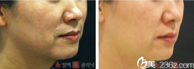 金美靜院長面部除皺案例 金美靜院長面部除皺案例