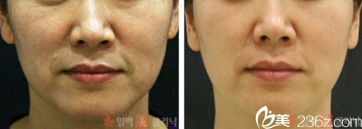 面部皺紋改善案例 面部皺紋改善案例